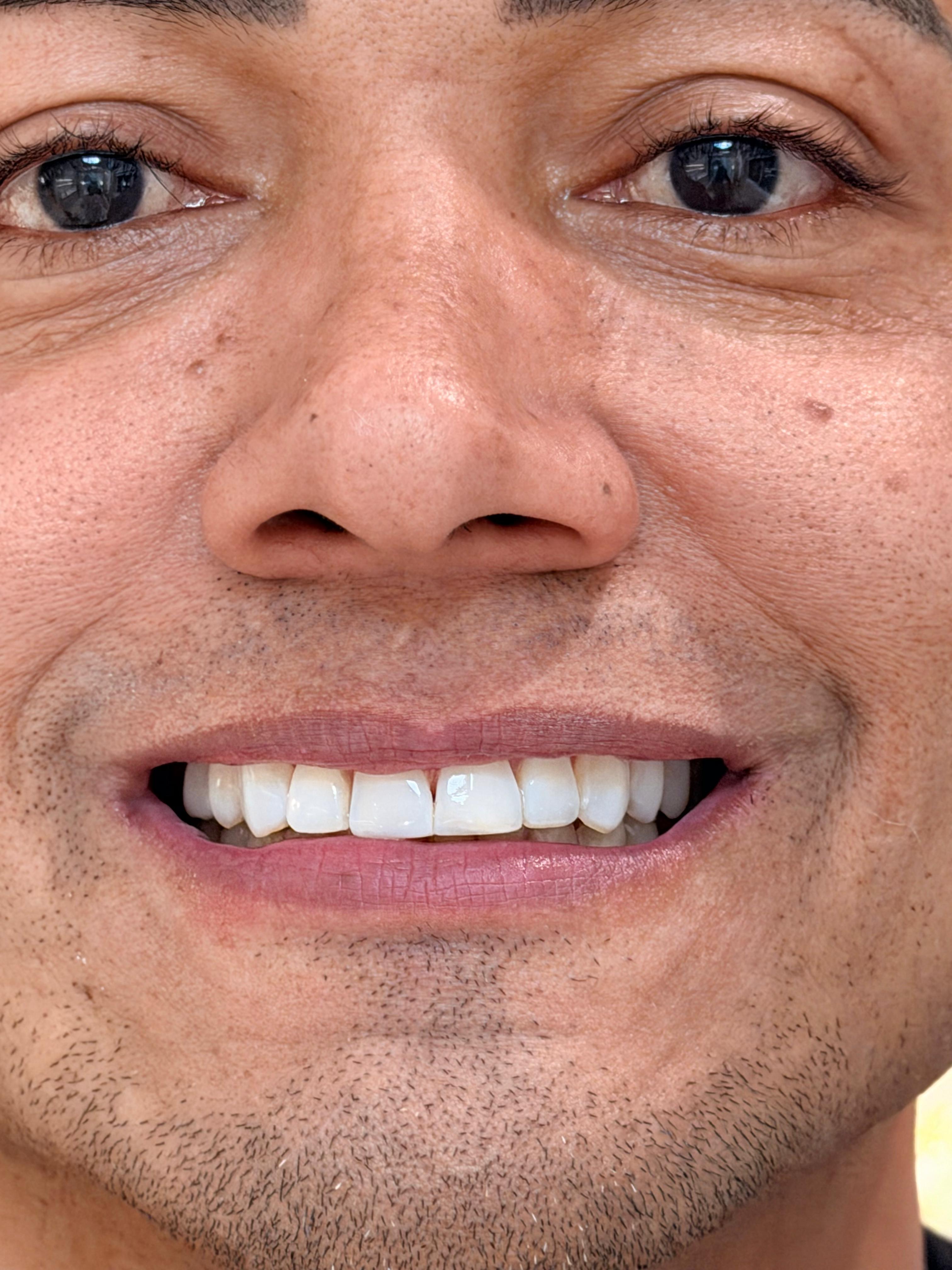 Facetas dentárias — depois do tratamento