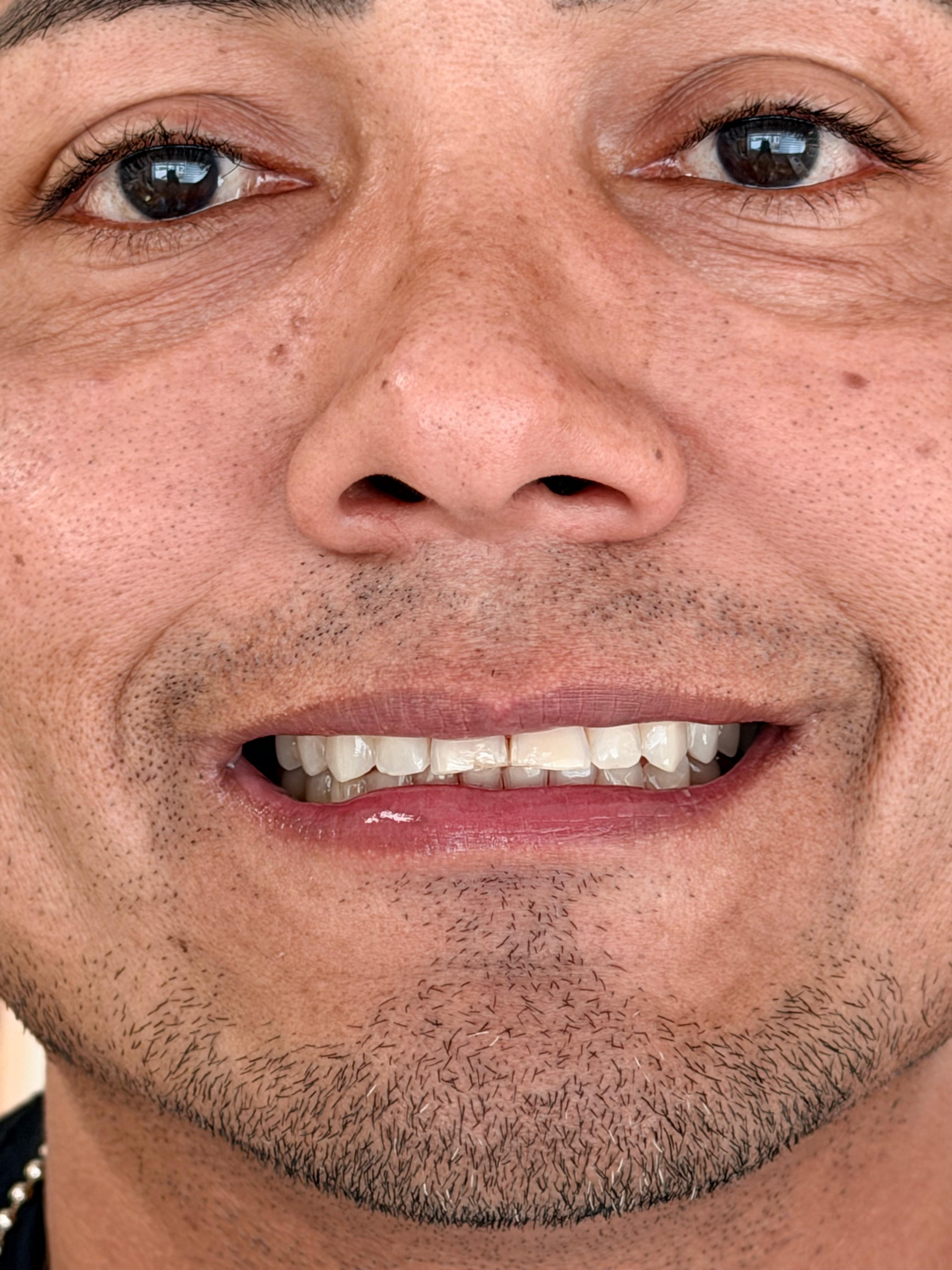 Facetas dentárias — antes do tratamento
