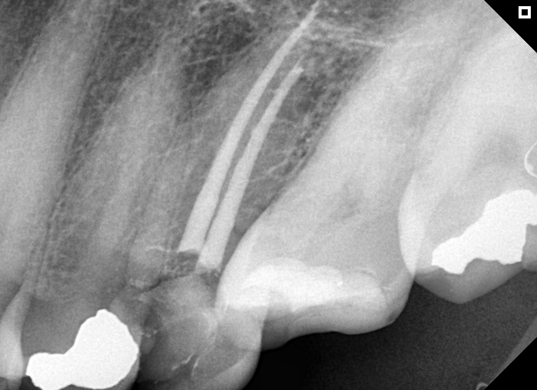 Radiografia de tratamento de canal — lima endodôntica nos canais radiculares