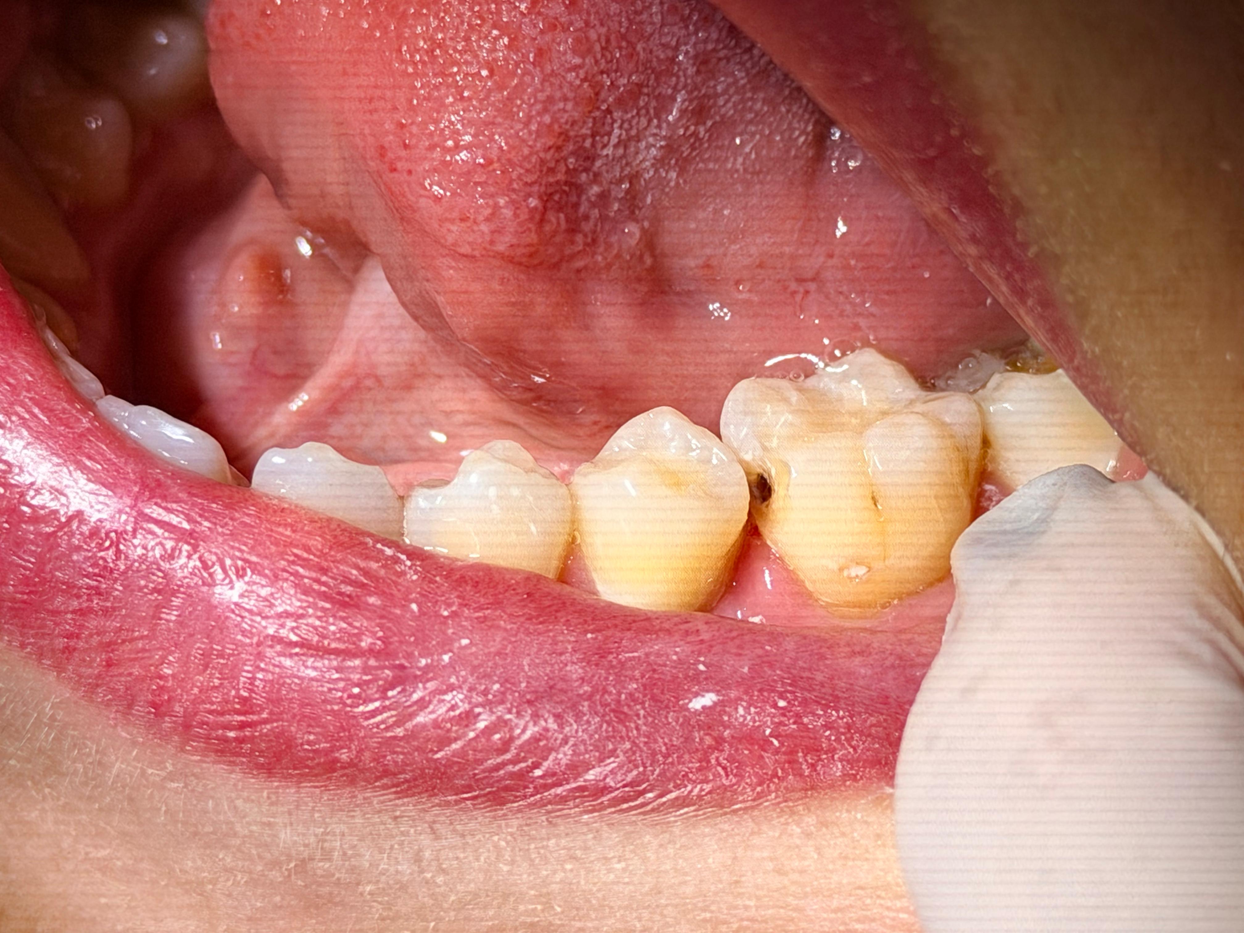 Cárie em dentes posteriores — antes do tratamento