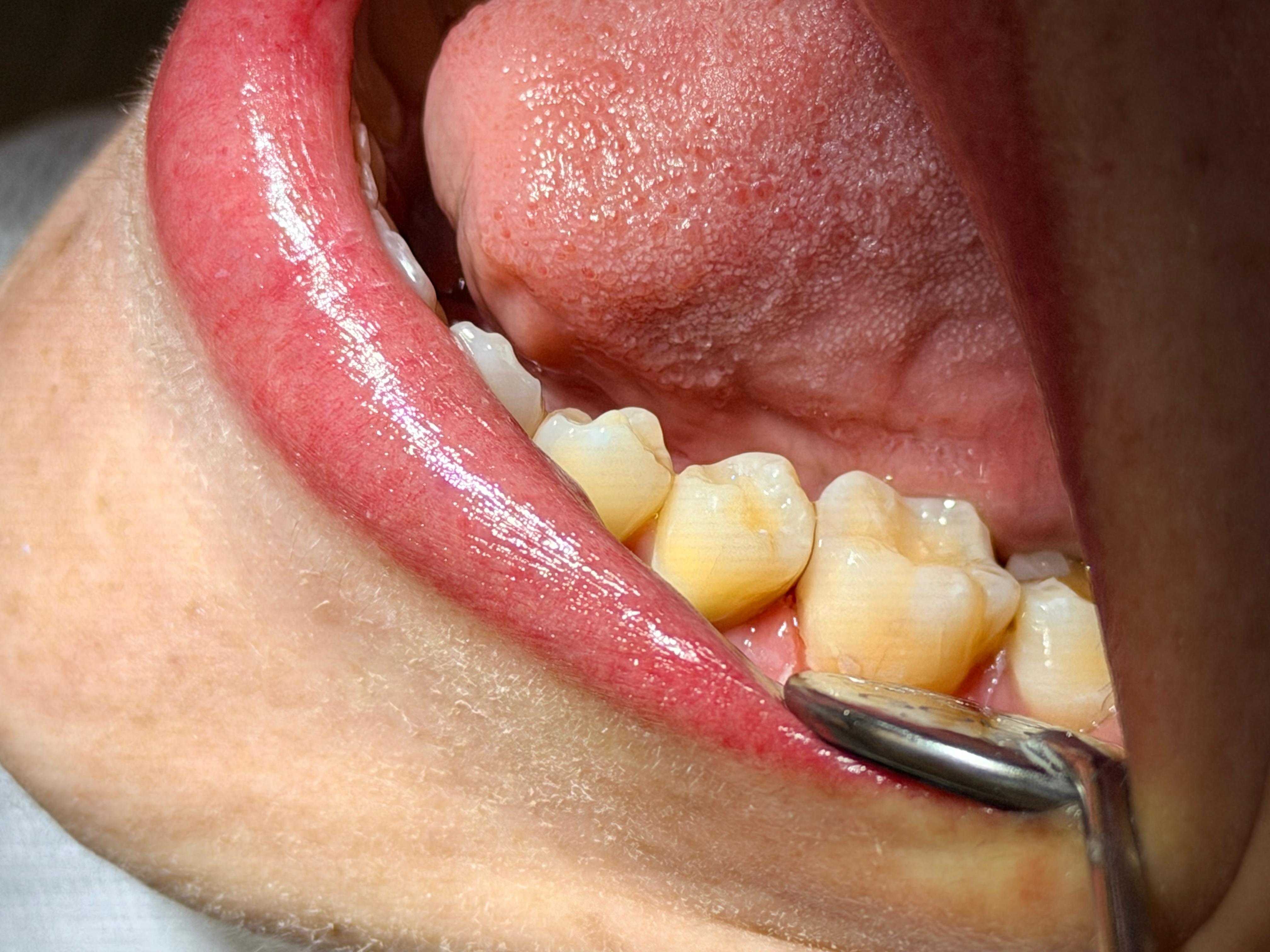 Dentes restaurados — resultado final