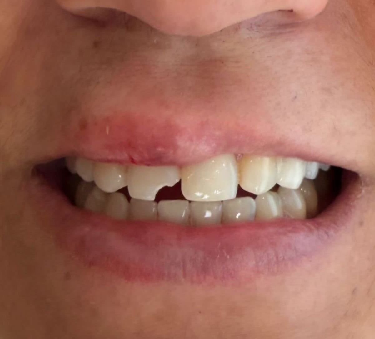 Dente fraturado — antes da restauração