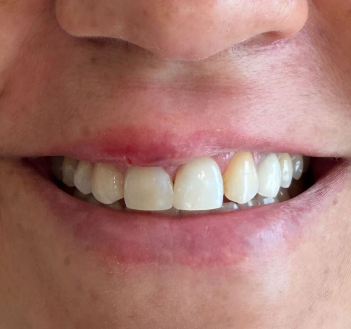 Dente restaurado — resultado final