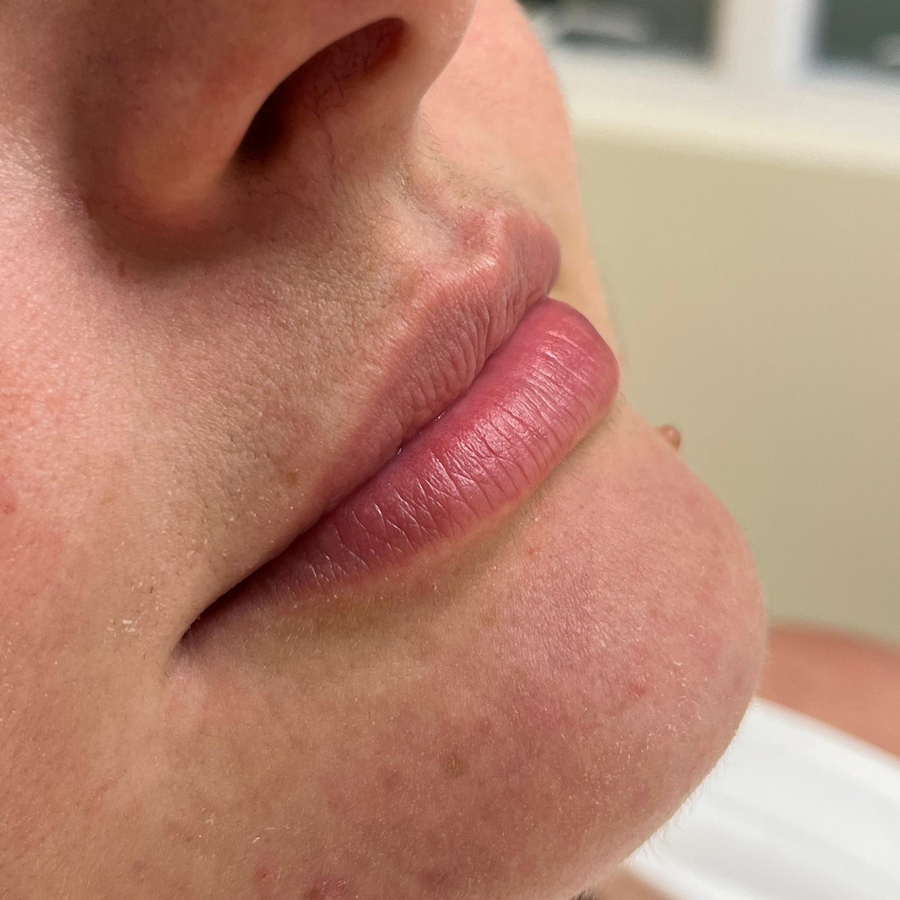 Preenchimento labial — antes do procedimento