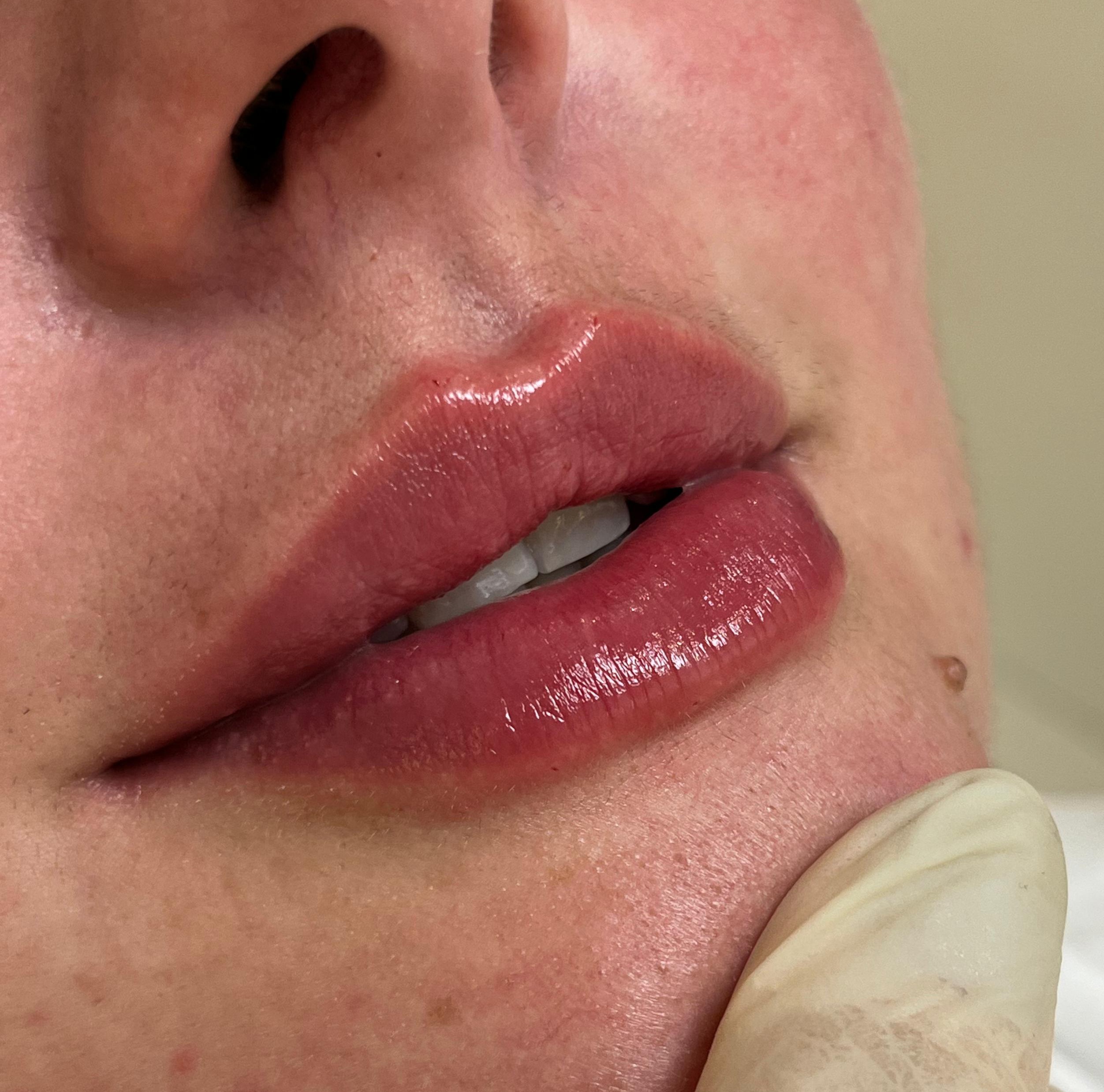 Preenchimento labial — após o procedimento