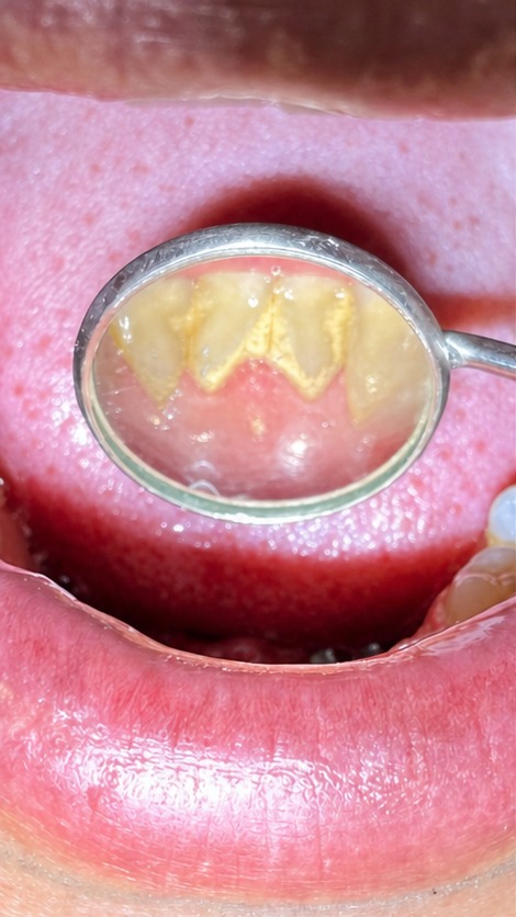 Profilaxia dental — antes (superior)