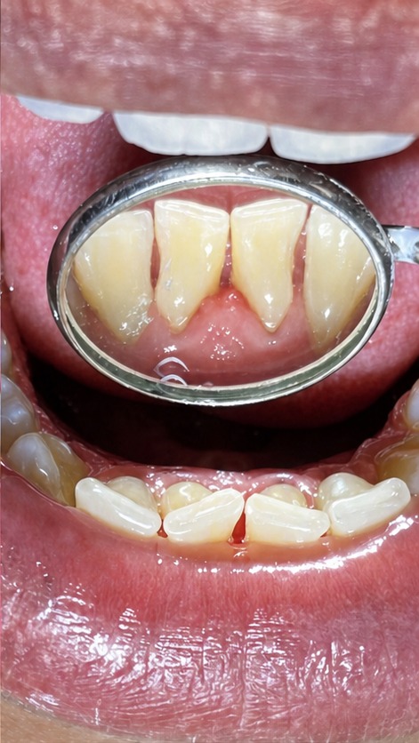 Profilaxia dental — depois (superior)