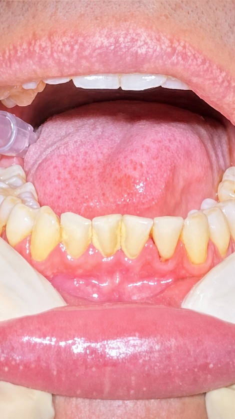 Profilaxia dental — antes (inferior)