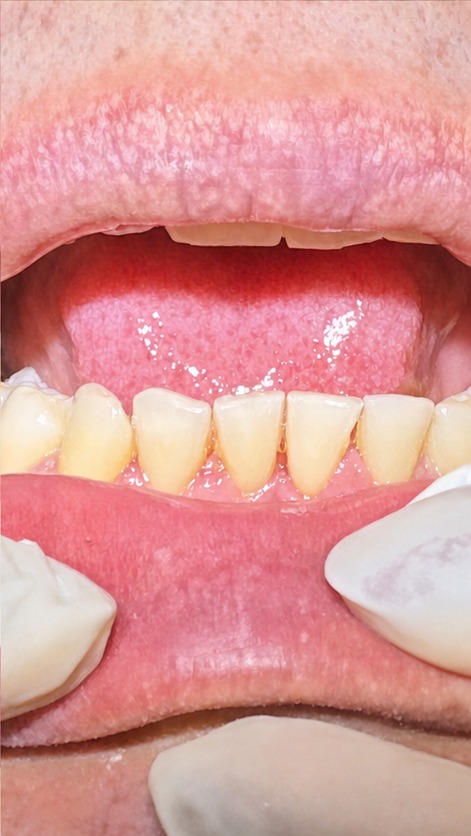 Profilaxia dental — depois (inferior)