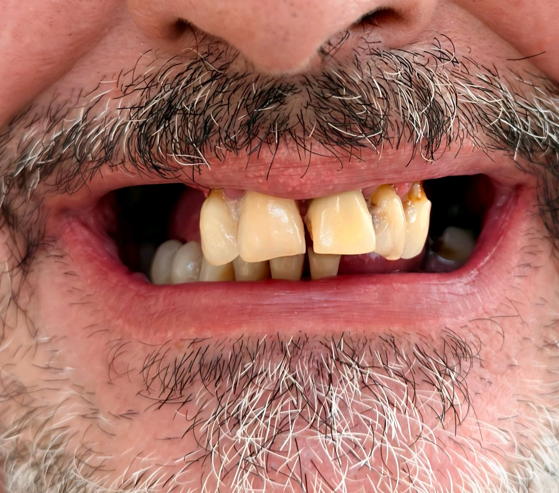 Prótese dentária — antes do tratamento