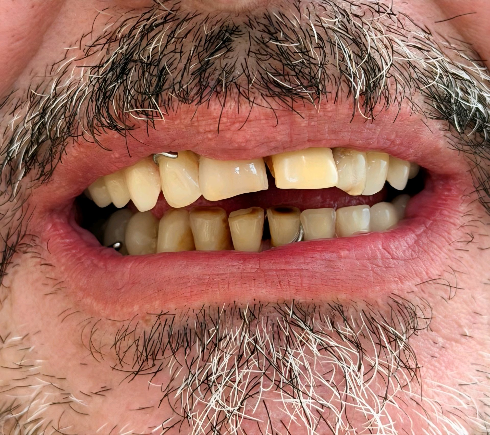 Prótese dentária — estado inicial