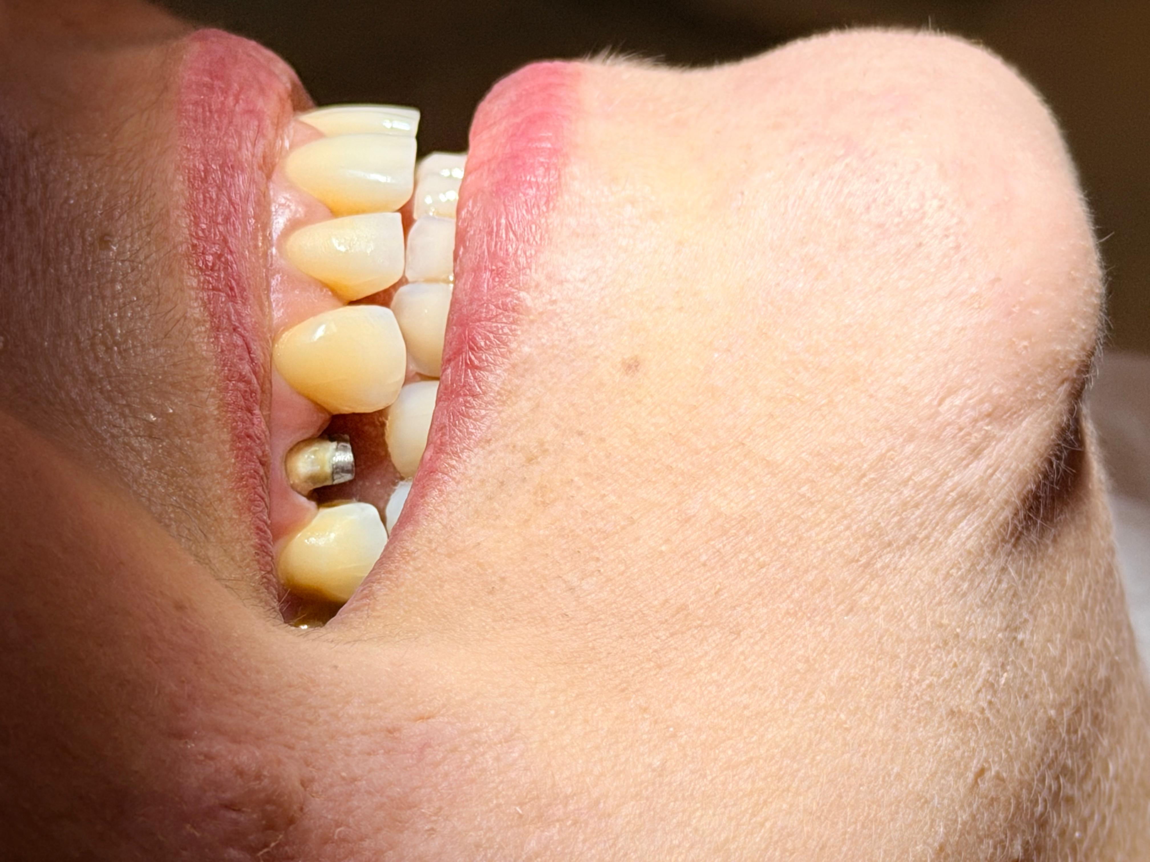 Implante dentário — antes da prótese