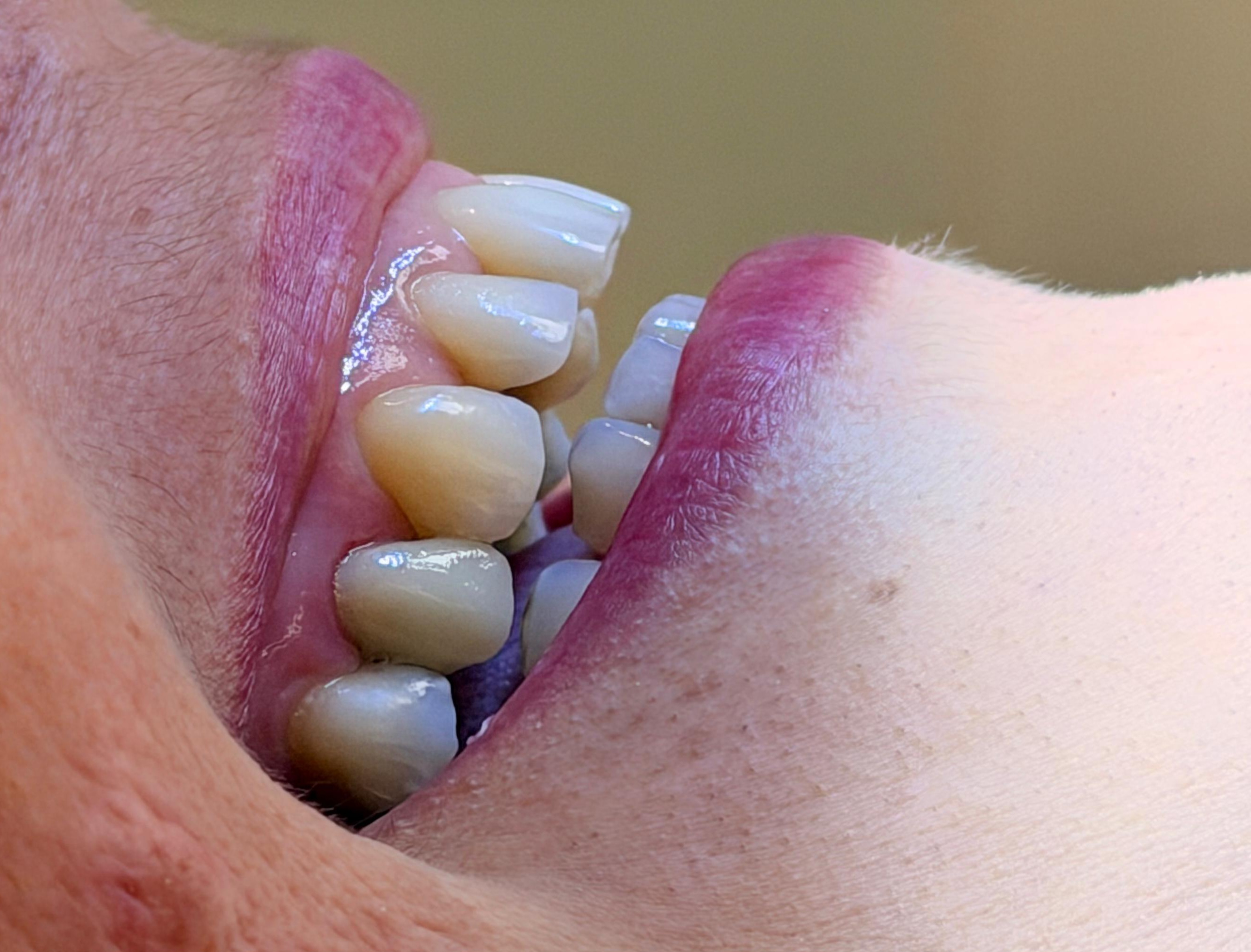 Implante dentário — depois da prótese