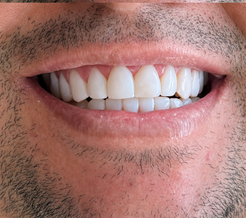 Restauração estética — depois